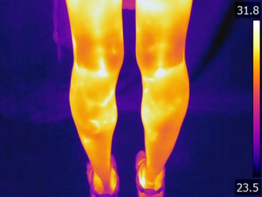 Foto aumento de temperatura debido a las varices circulacio n venosa en las piernas ibv 27608